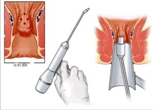 Tiêm xơ nội soi
