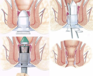 PHƯƠNG PHÁP TRỊ BỆNH TRĨ - BÁC SĨ TRƯỞNG