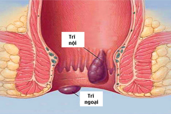 Bệnh trĩ ở phụ nữ