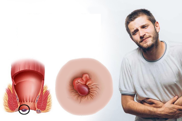 Tiêm trĩ bác sĩ Trưởng Lê Bệnh trĩ ở người cao tuổi