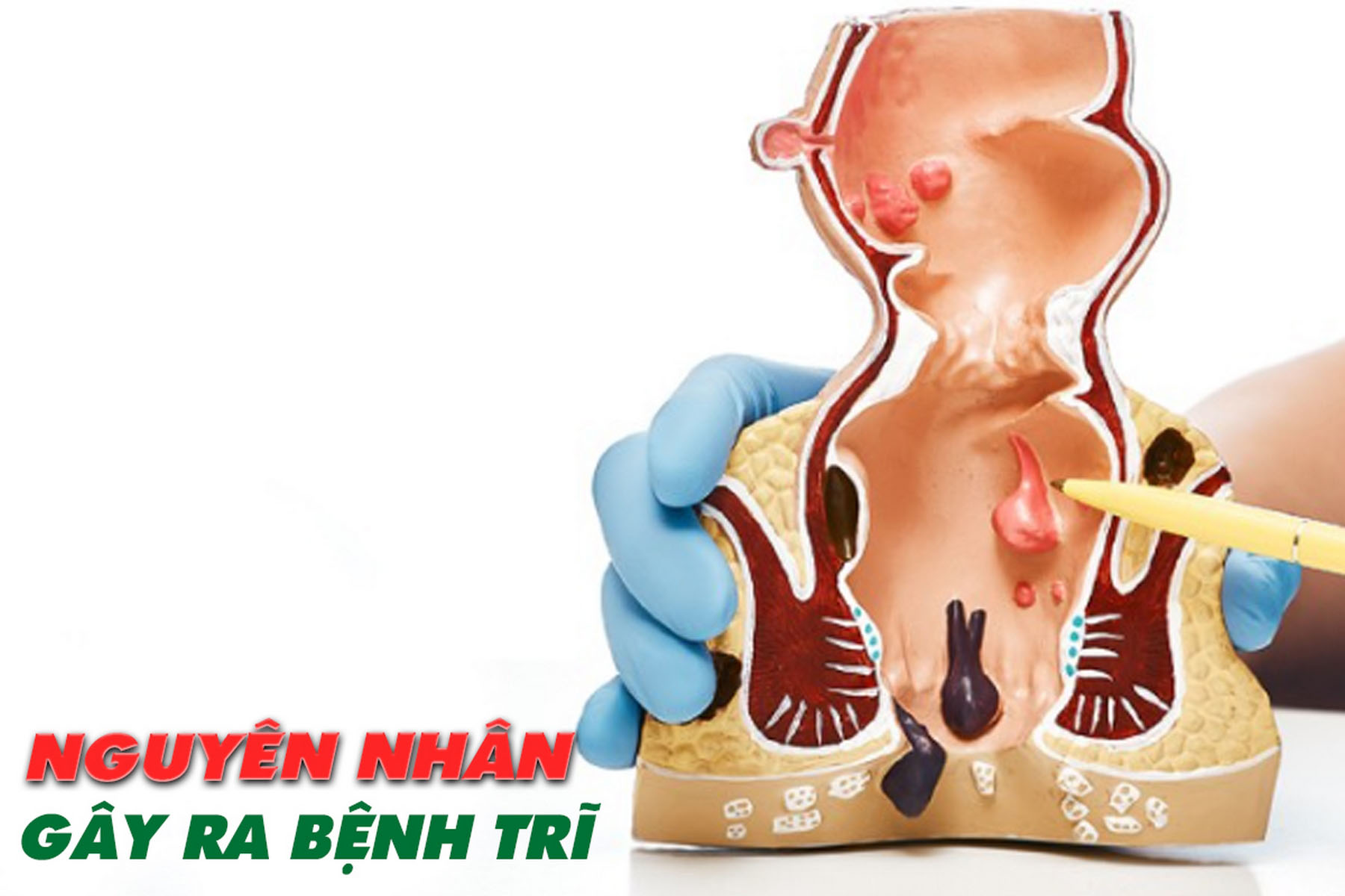 BÁC SĨ TRƯỞNG - BỆNH TRĨ CÓ NGUY HIỂM KHÔNG? NGUYÊN NHÂN VÀ PHƯƠNG PHÁP ĐIỀU TRỊ