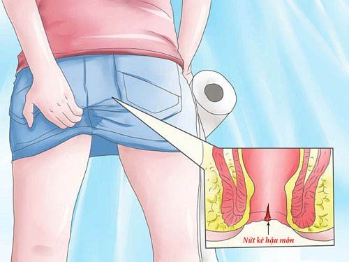 CẢNH BÁO DẤU HIỆU NỨT KẼ HẬU MÔN
