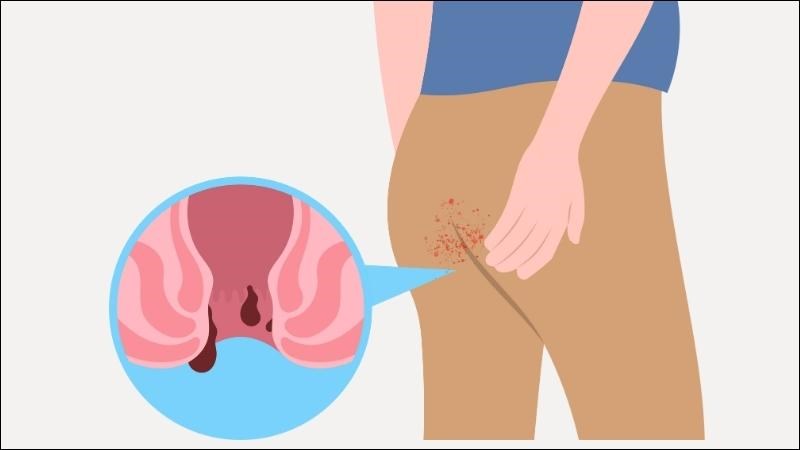 Dấu hiệu nứt kẽ hậu môn