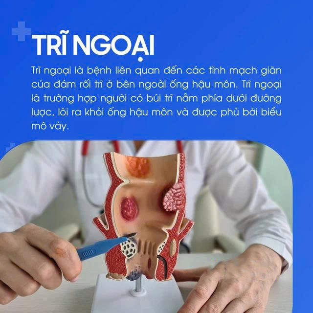trĩ ngoại là gì