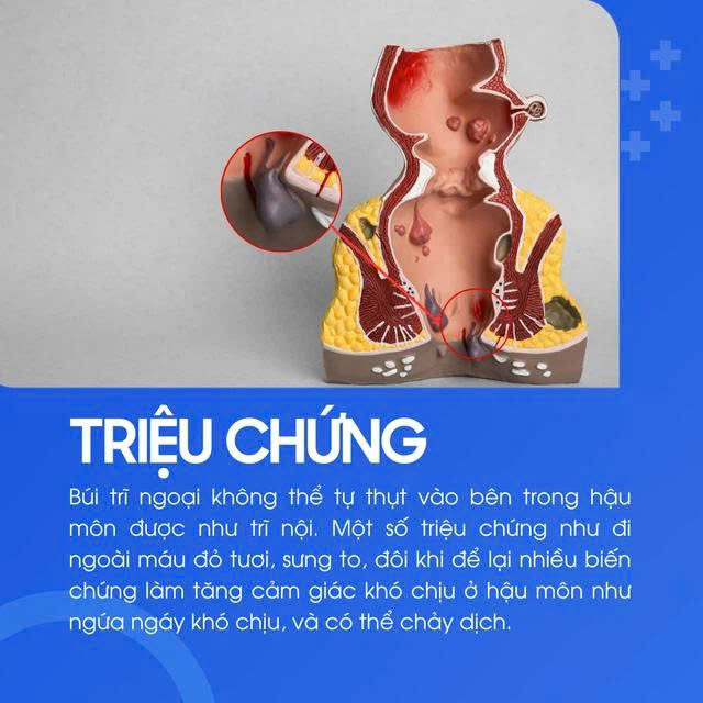 trĩ ngoại là gì