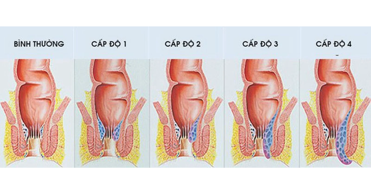 Các cấp độ thường gặp ở bệnh trĩ nội