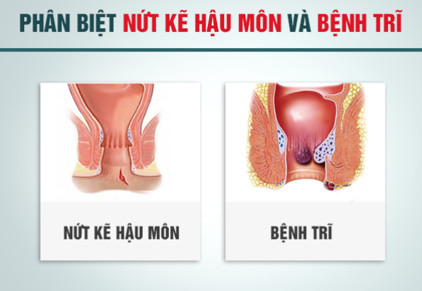 nứt kẽ hậu môn