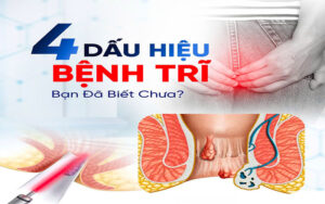 bác sĩ trưởng- 4 dấu hiệu của bệnh trĩ