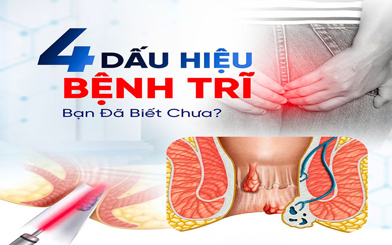 bác sĩ trưởng- 4 dấu hiệu của bệnh trĩ