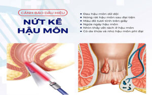 Cảnh báo dấu hiệu nứt kẽ hậu môn