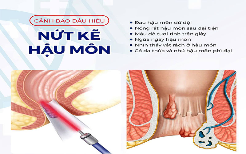 Cảnh báo dấu hiệu nứt kẽ hậu môn