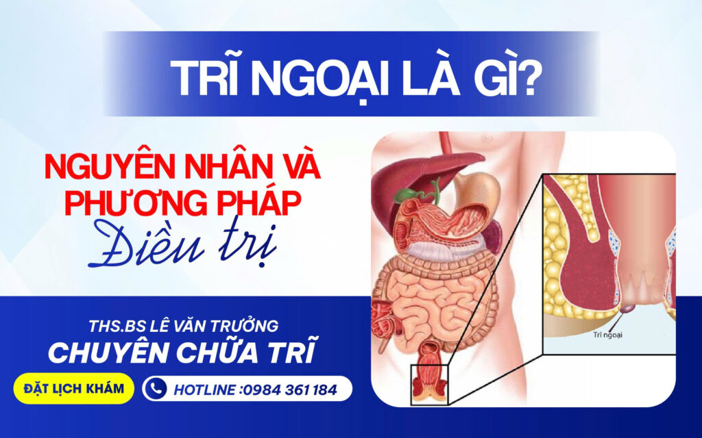 trĩ ngoại là gì